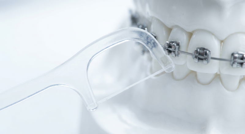 Floss picks for braces: how they work around wires and brackets