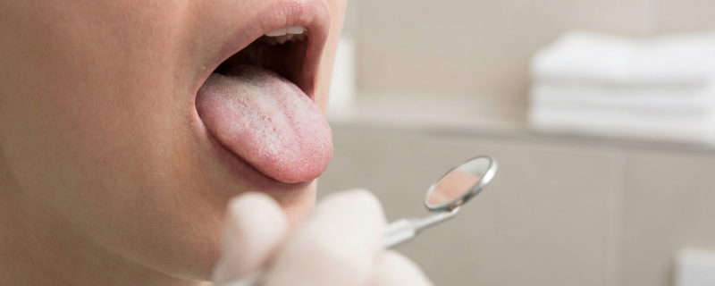 White tongue: common causes and when to see a dentist