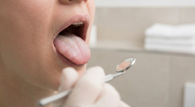 white tongue causes closeup oral thrush leukoplakia
